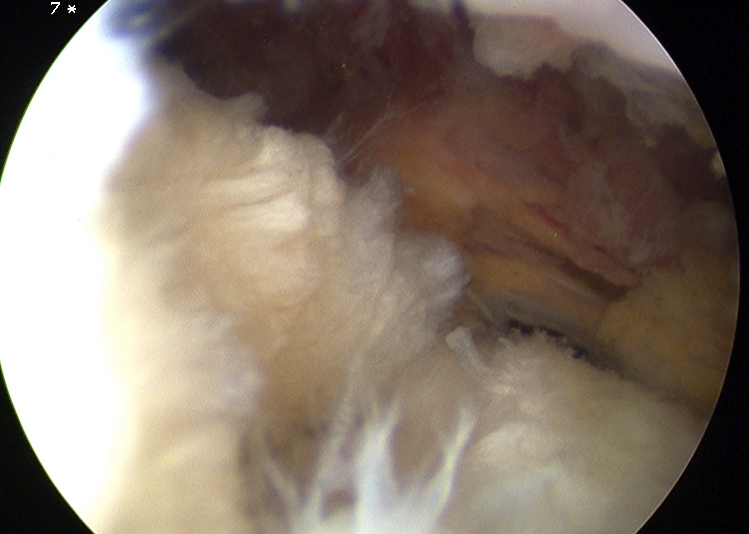 Bursal Sided Supraspinatous Tear